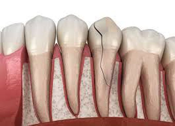 symptoms of a cracked tooth