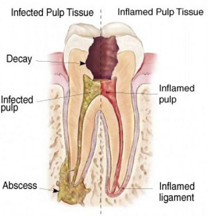 Causes of pulpitis