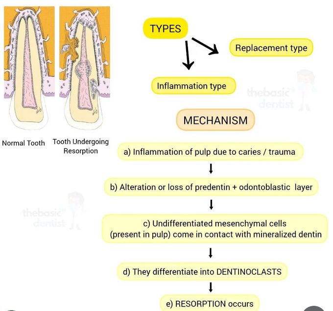 Internal Resorption III
