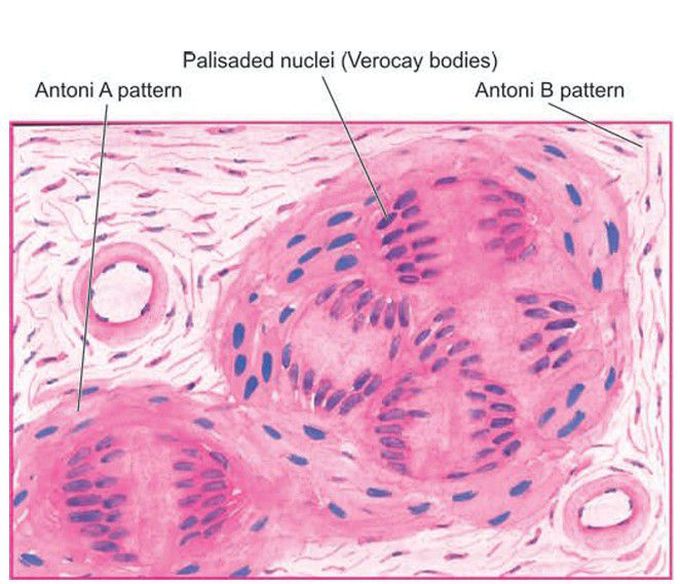 Schwannoma