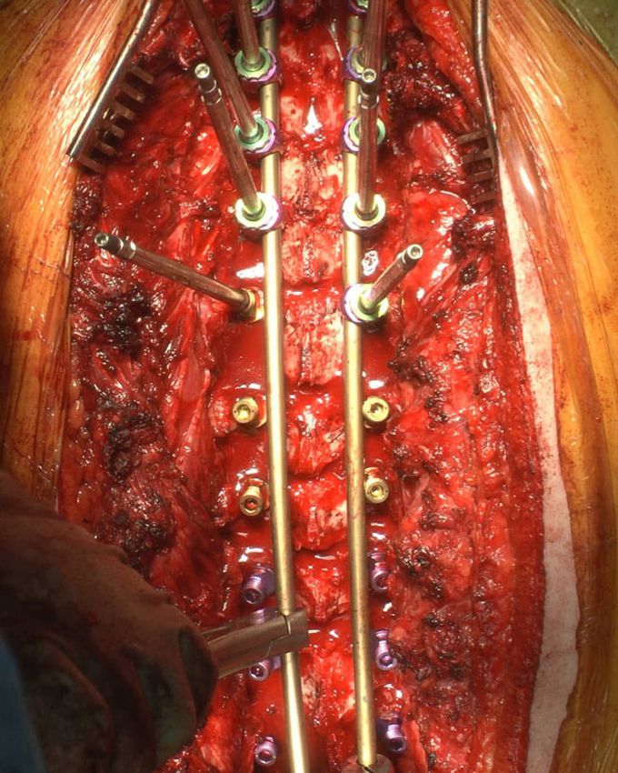 ⚠️ Intraoperative view of scoliosis surgery. 