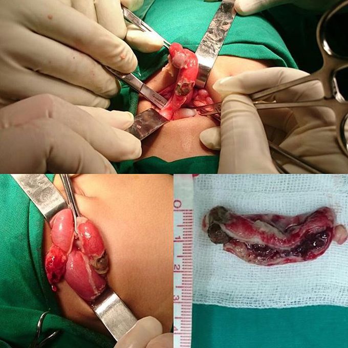 1 y.o boy presenting with tenderness all quadrants on his abdomen