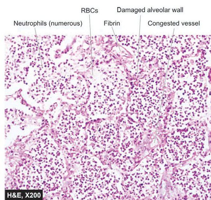 Lobar pneumonia