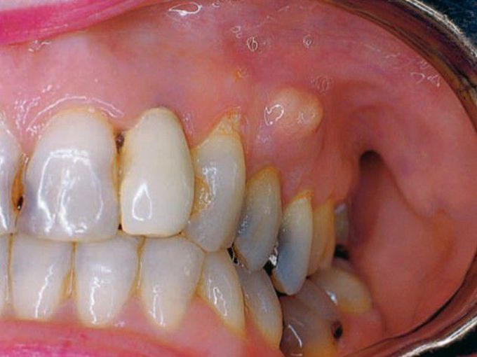 Gingival abscess