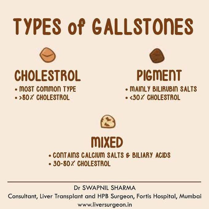 Types of Gallstones