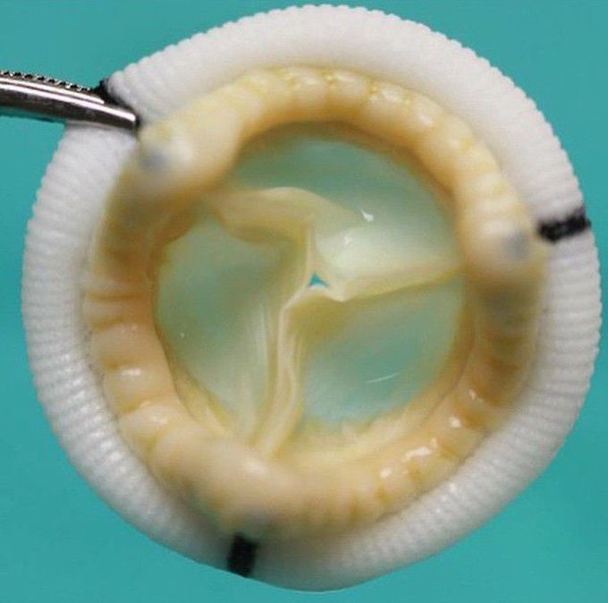 Heart valve prosthesis