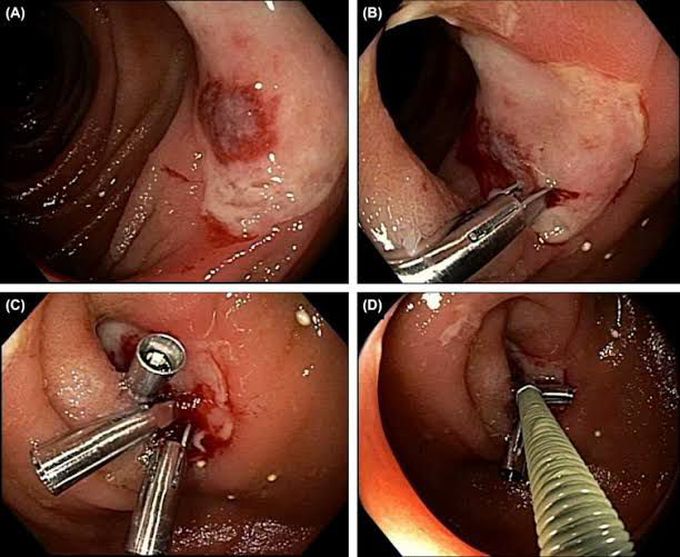 Management of rectal bleeding