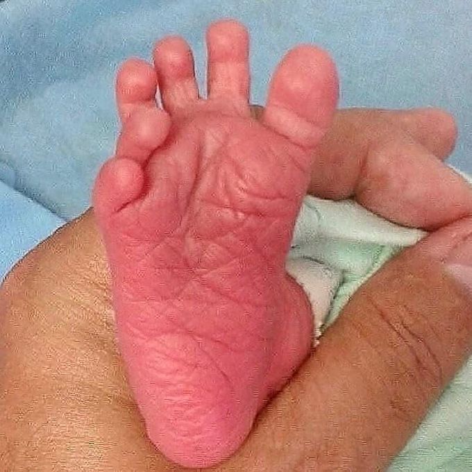 Polydactyly
