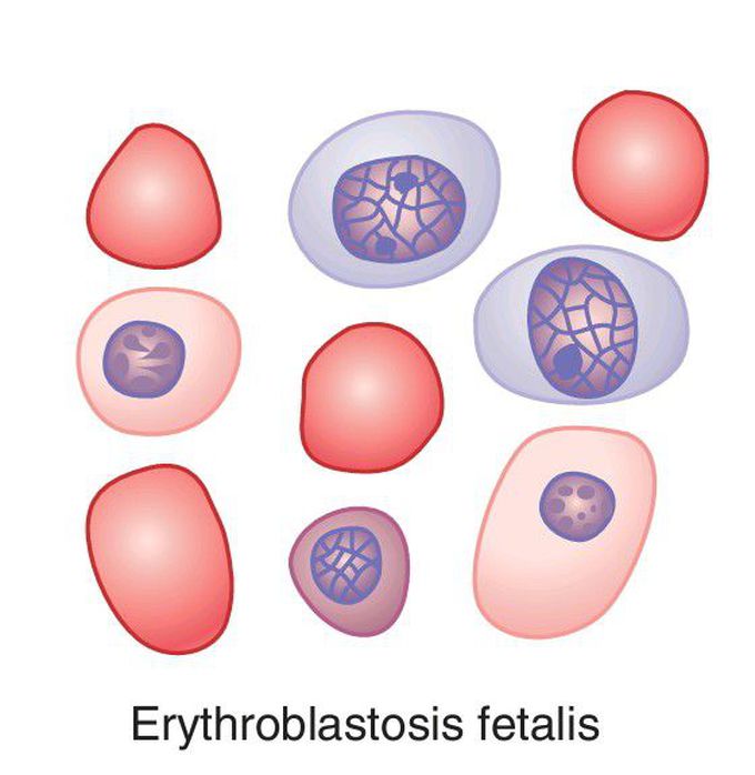 Characteristics of RBCs in different types of anemias.(4)