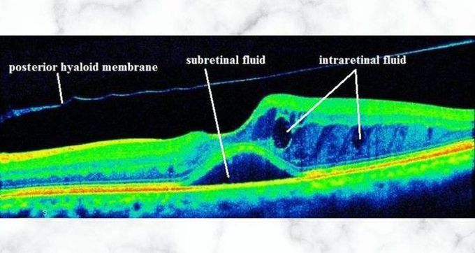 Diabetic Macular Oedema Medizzy