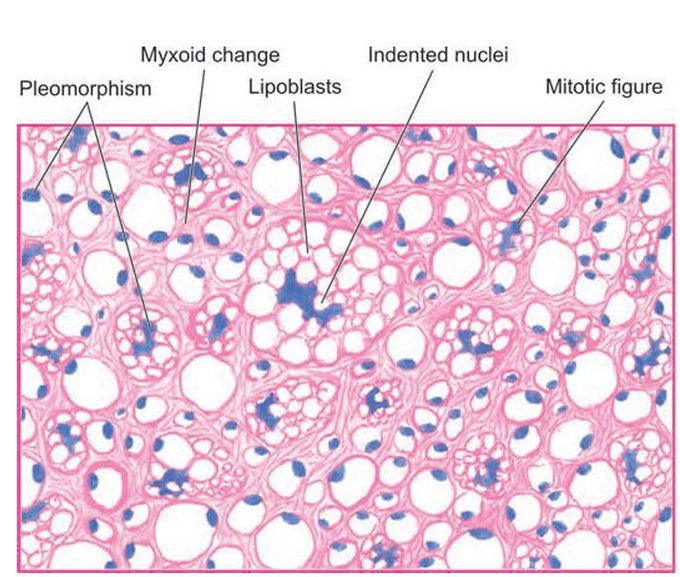 Liposarcoma