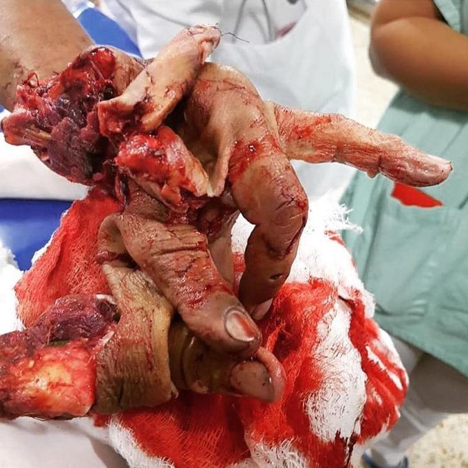 The left hand caught within the meat grinder.