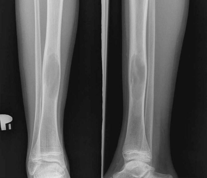Is PRP safe enough? A case report of an allergic reaction to PRP