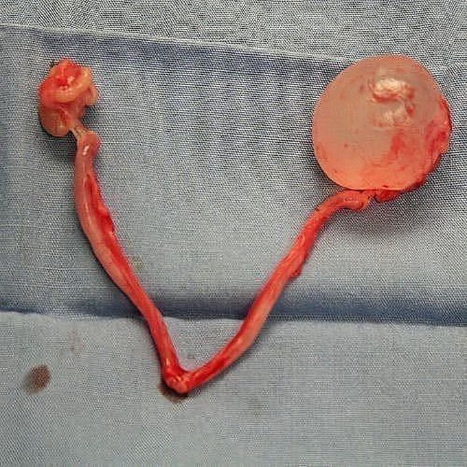 A fluid-filled ovarian cyst