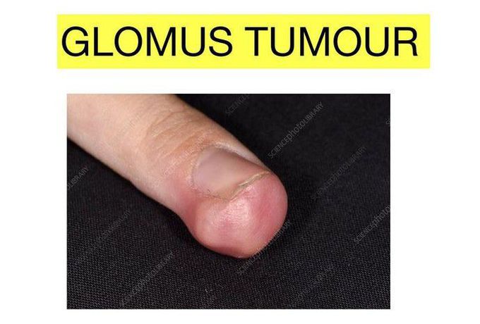 Glomus Tumor