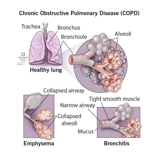 Why does COPD happens? - MEDizzy