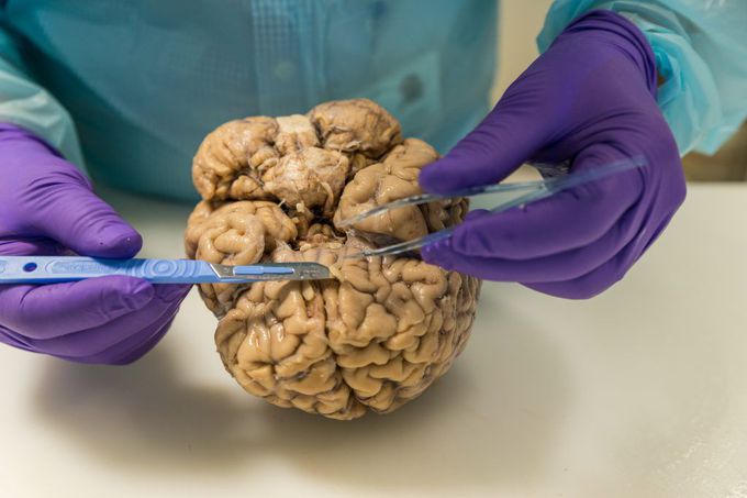 Woman's Runny Nose Was Actually Leaking Brain Fluid, Doctors Say