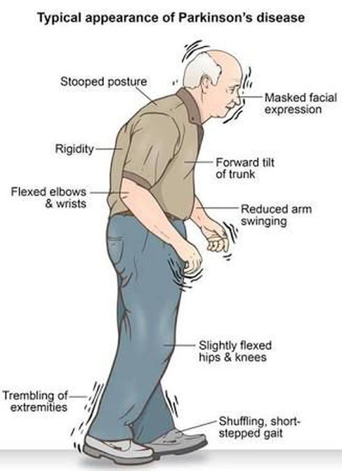 Parkinson's disease