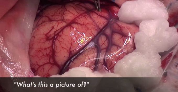 Awake Craniotomy