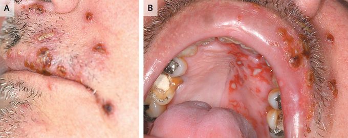 Lesions in the Oral Cavity