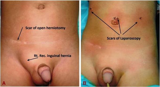 Inguinal hernia