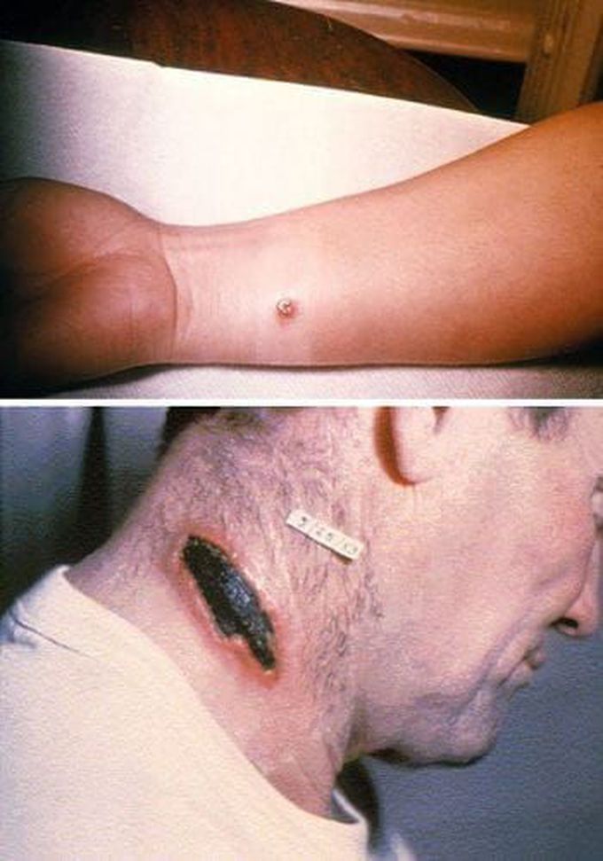 Types of anthrax