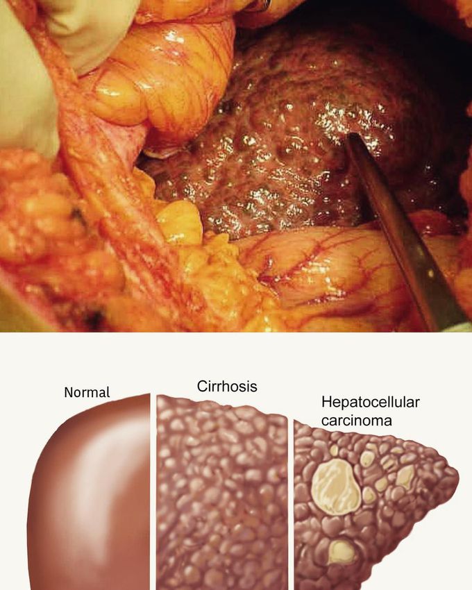Liver Cirrhosis