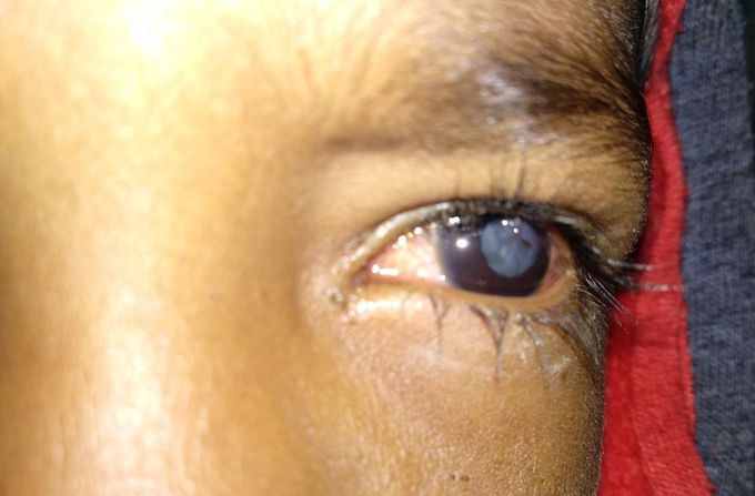 Mature Cataract.