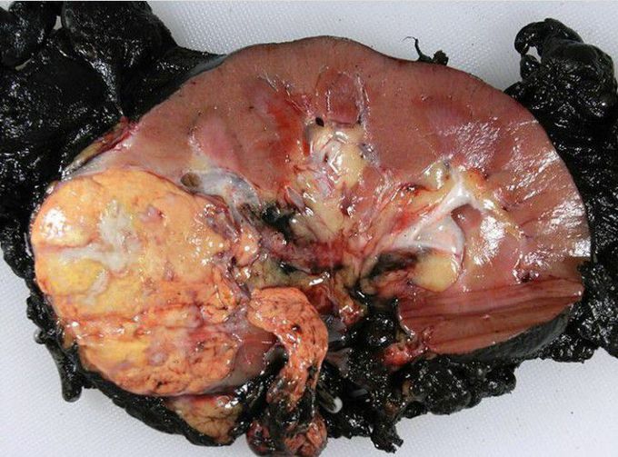 Kidney cancer