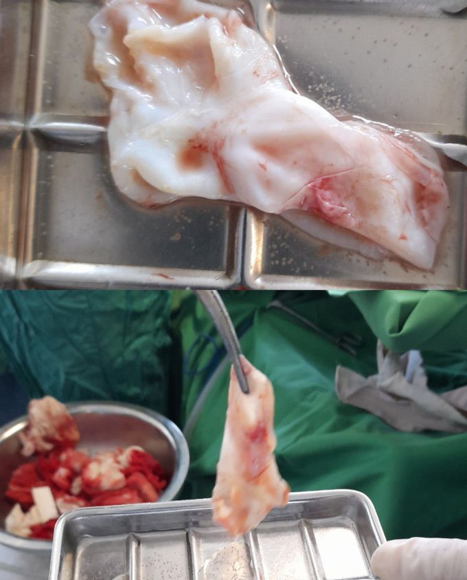 Hydatid cysts of the liver,total cystectomy
