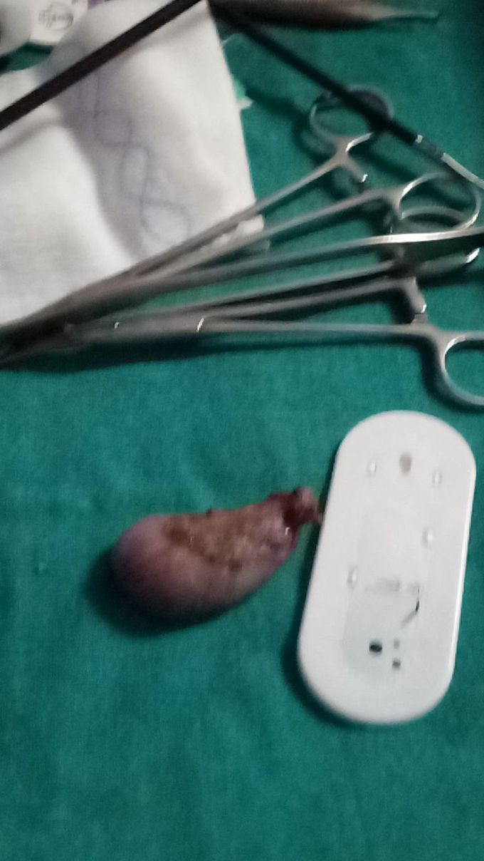 Cholecystectomy by laproscopy