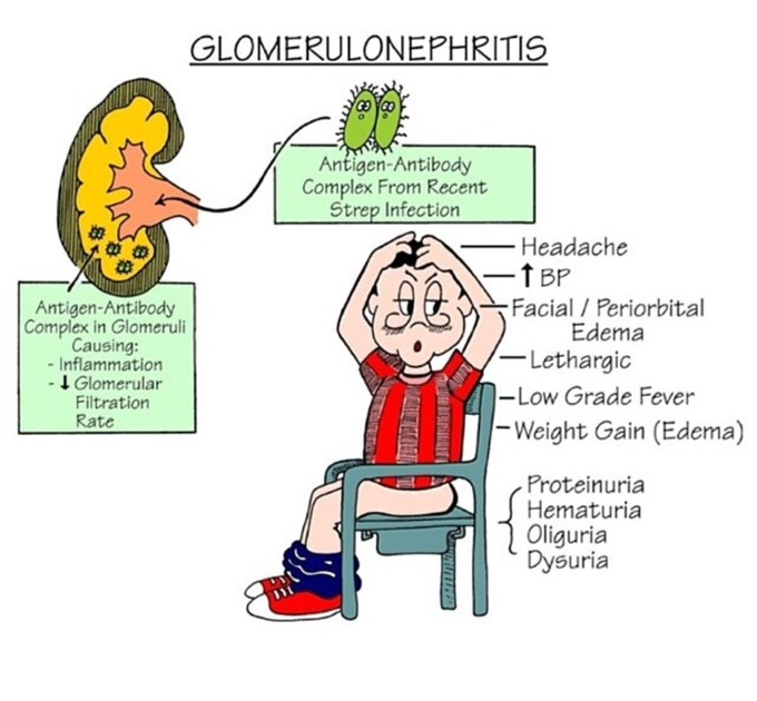 Glomerulonephritis