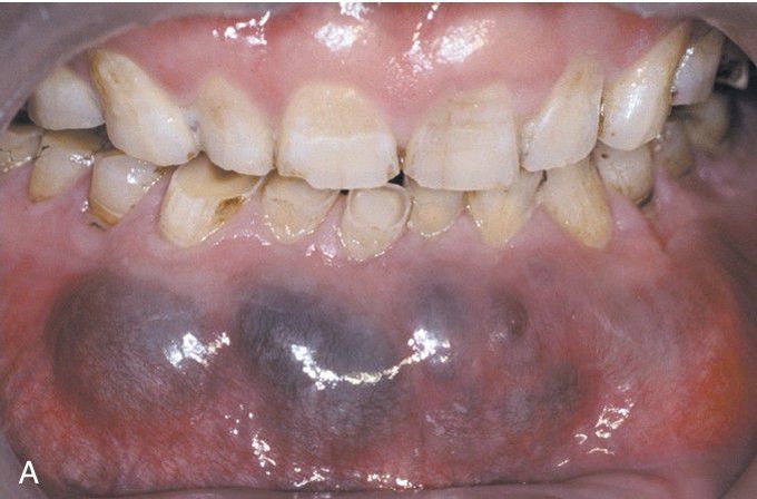 Glandular Odontogenic Cyst.