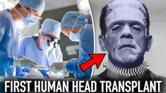 First Successful Human Head Transplant 2017  | Dr Sergio Canavero (a.k.a Frankenstein)