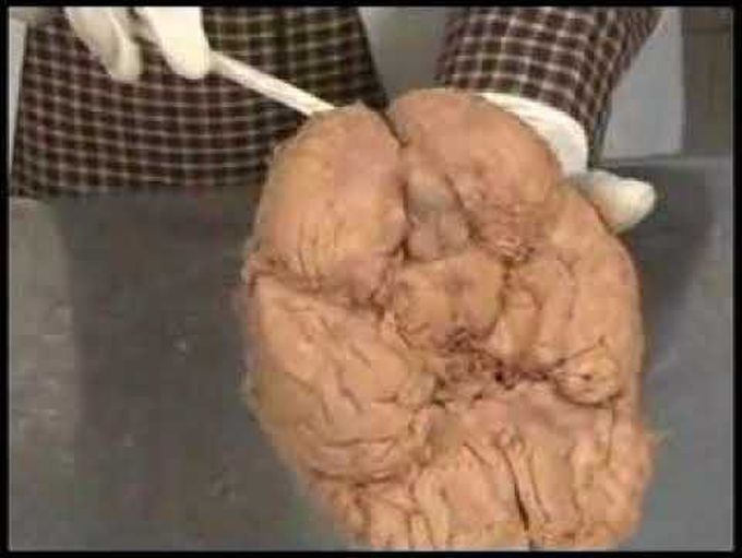 Cerebellum