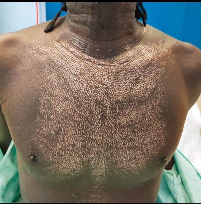 Salt-and-Pepper Skin Changes in Systemic Sclerosis
