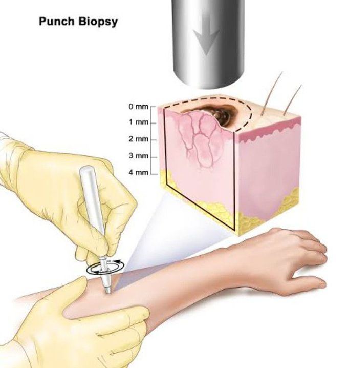 Treatment for Melanoma