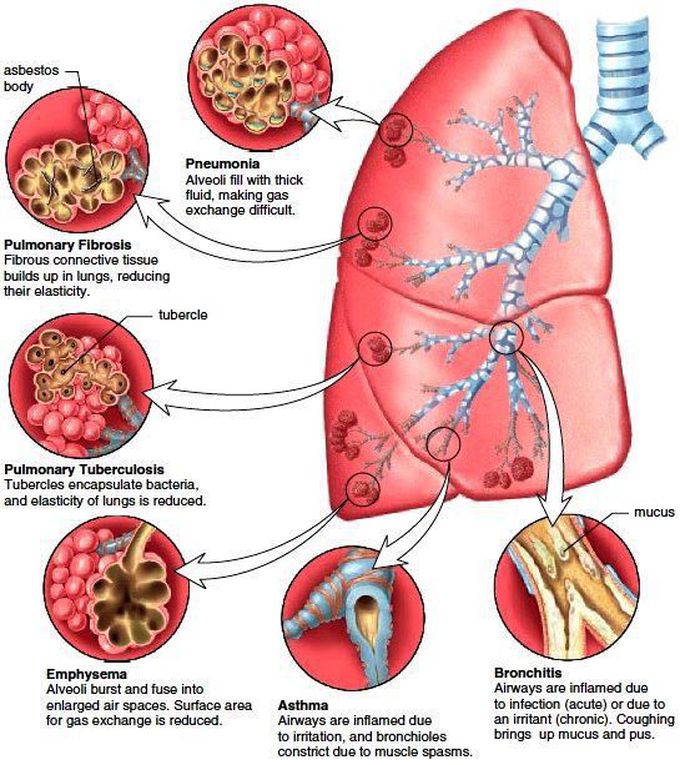 Pathology of the most common diseases of Respiratory system