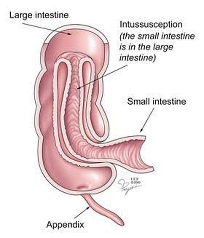 What is Intussusception?