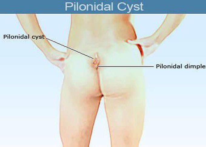 Pilonidal cyst Flashcards