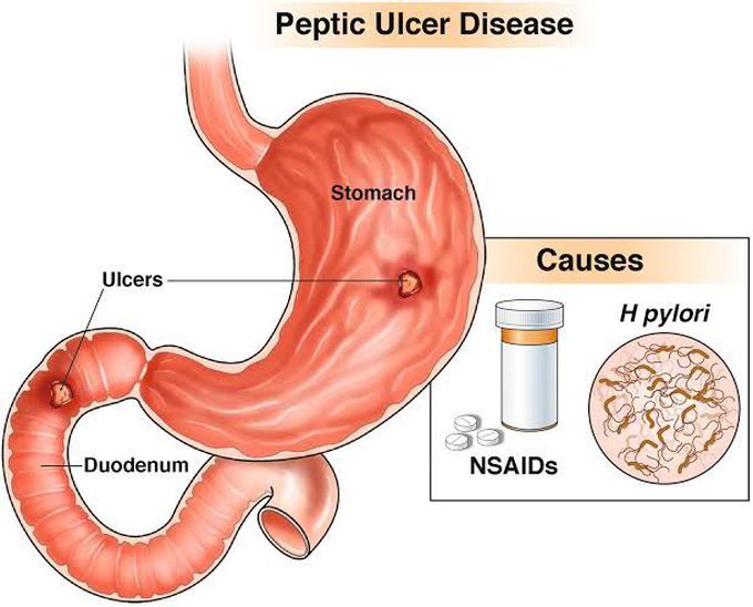 Peptic ulcer disease