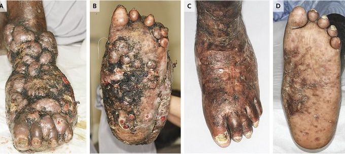 Actinomycetoma