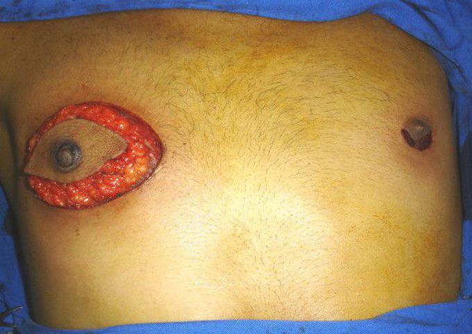 Surgery. Modified radical mastectomy (right breast) and retroareolar lumpectomy (left breast).
