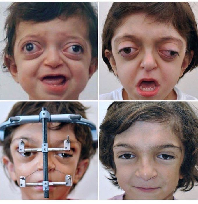 Crouzon Syndrome