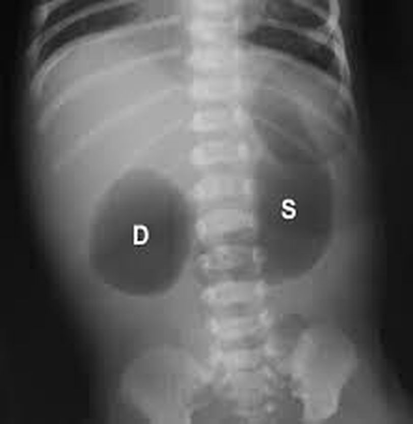 double bubble duodenal atresia