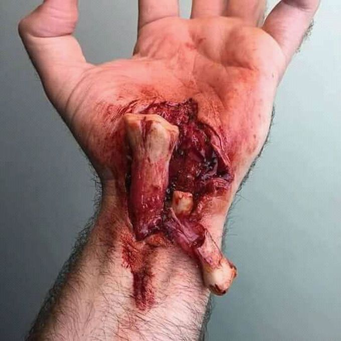 Name this bone injury???