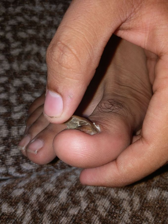 Pulled nail