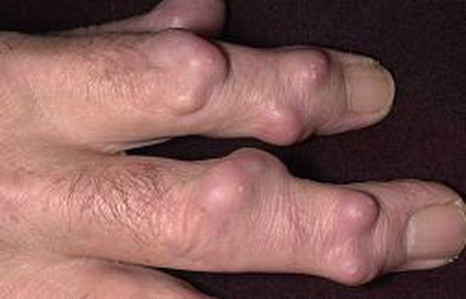 You see these nodules in which disease!??