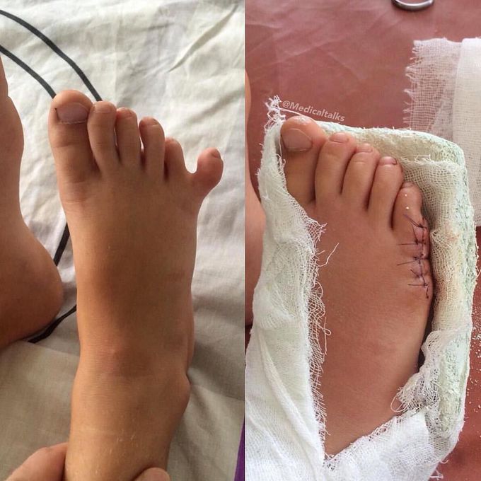Polydactyly