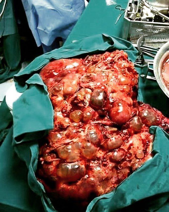 Polycystic liver disease